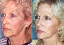 Co2 laser resurfacing anti wrinkles treatment