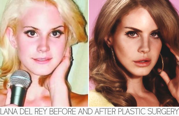Lana del Rey before and after plastic surgery